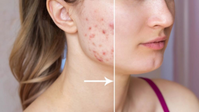 How to Get Rid of Acne Scars