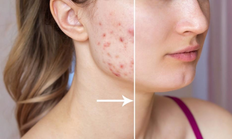 How to Get Rid of Acne Scars